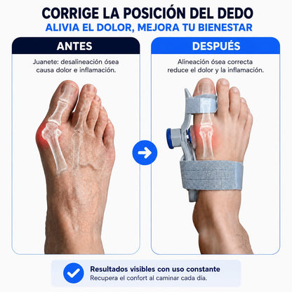 Corrector para alineación del hallux valgus (Juanete)